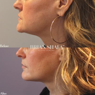 Ultherapy  Before & After Gallery - Patient 40314656 - Image 1