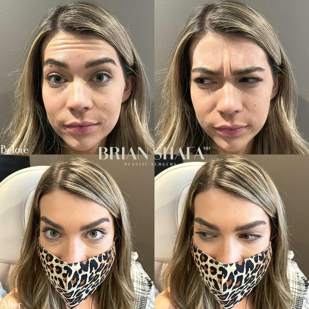 Injectables Before & After Photos - Patient 40314666 - Image 1