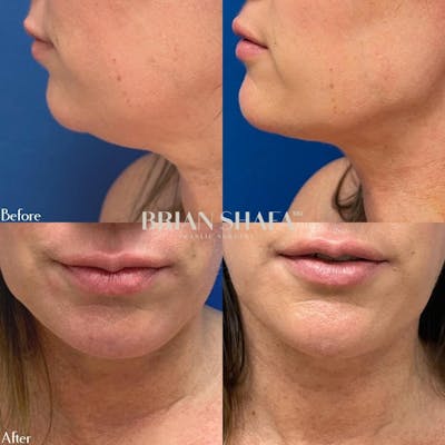Liposuction Before & After Gallery - Patient 40314674 - Image 1