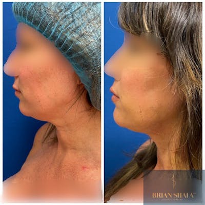 Liposuction Before & After Gallery - Patient 40314696 - Image 1