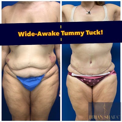 Tummy Tuck (Abdominoplasty) Before & After Photos - Patient 40314727 - Image 1