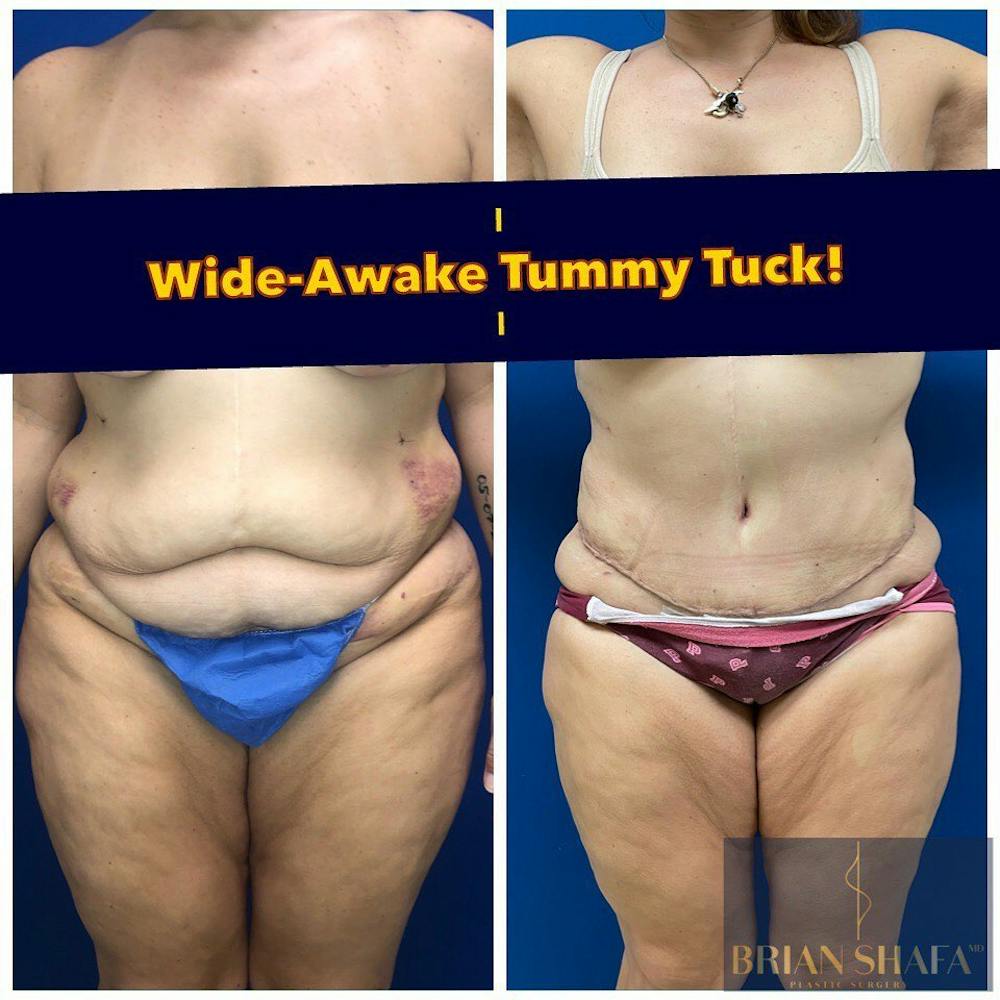 Tummy Tuck/ Abdominoplasty Before & After Gallery - Patient 40314727 - Image 1