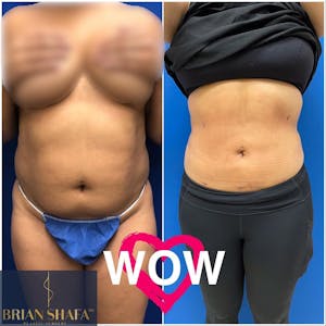 liposuction 1