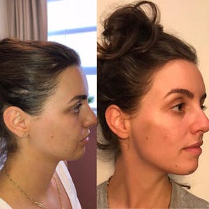 dermal fillers in Beverly Hills & Santa Monica before and after photos