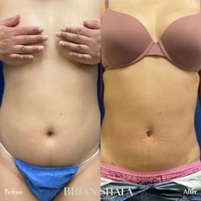 Liposuction Before & After Photos - Patient 44539538 - Image 1