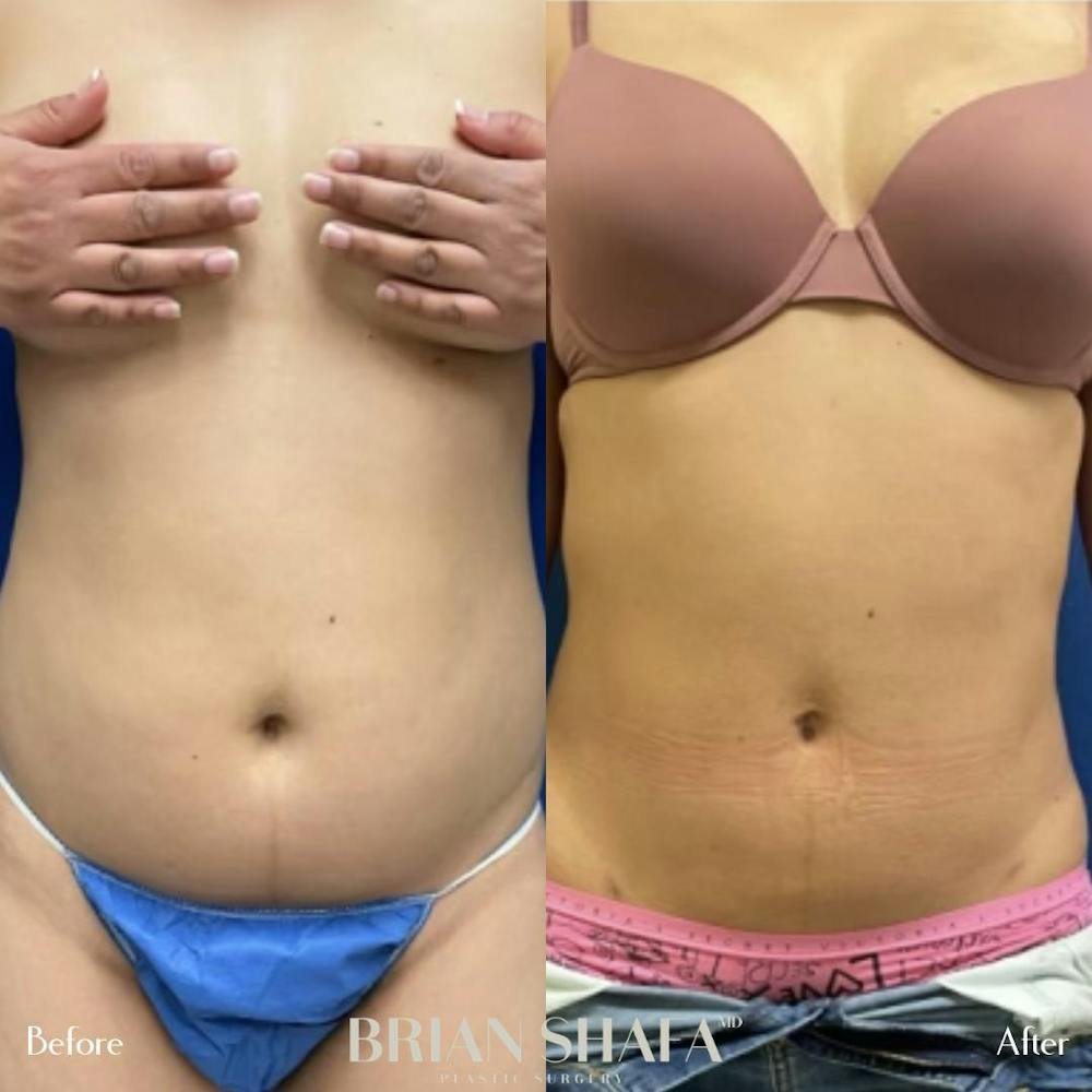 Liposuction Gallery - Patient 44539538 - Image 1