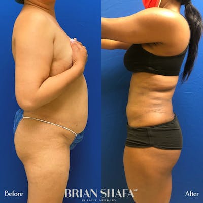 Liposuction Gallery - Patient 48796023 - Image 1