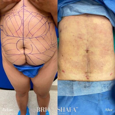 Liposuction Gallery - Patient 48796023 - Image 2
