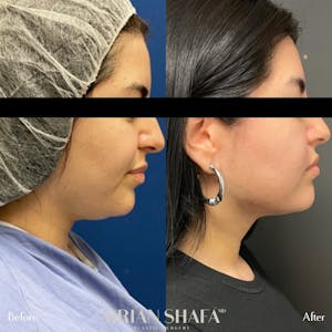 neck liposuction in Beverly Hills & Santa Monica before and after photos