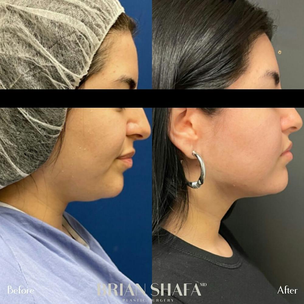 Jawline Contouring  Before & After Gallery - Patient 48796099 - Image 1