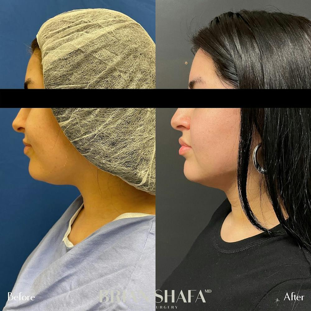Jawline Contouring  Before & After Gallery - Patient 48796099 - Image 2
