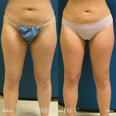 Liposuction Before & After Photos - Patient 54674992 - Image 1