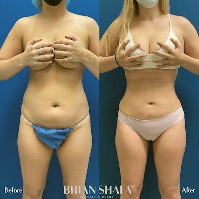 Liposuction Before & After Photos - Patient 54674998 - Image 1