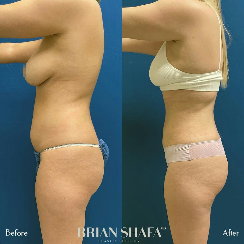 Liposuction Before & After Photos - Patient 54674998 - Image 2