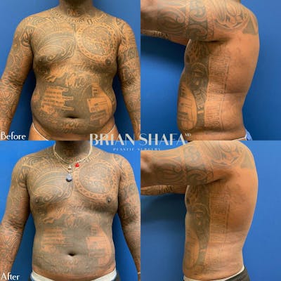 Liposuction Before & After Photos - Patient 54675040 - Image 1