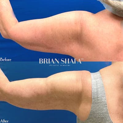 Arm Liposuction Before & After Photos - Patient 782934 - Image 1