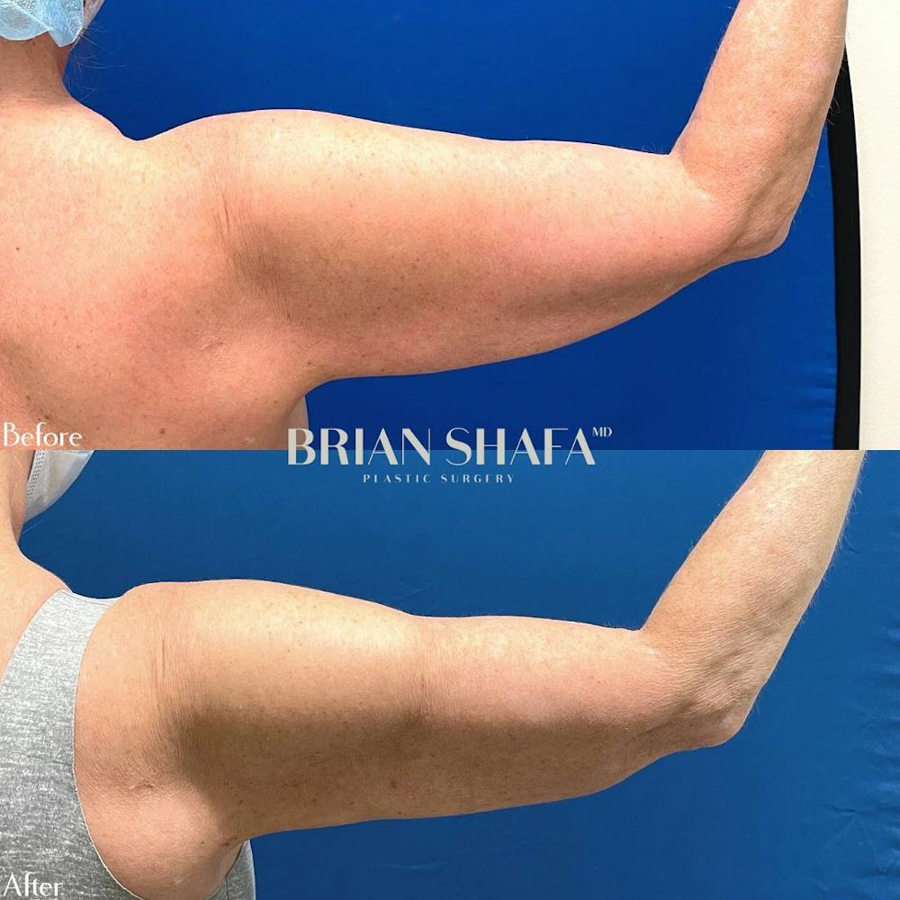 High-Def Liposuction  Before & After Photos - Patient 54675051 - Image 3