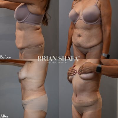 Tummy Tuck (Abdominoplasty) Before & After Photos - Patient 72241591 - Image 1