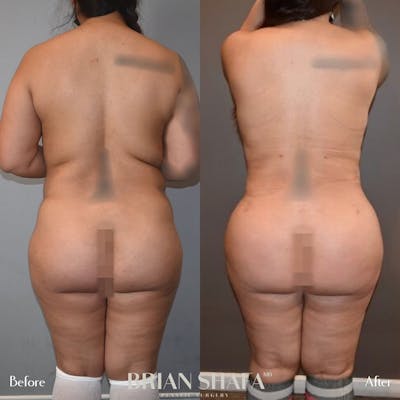 Brazilian Butt Lift Before & After Photos - Patient 96913501 - Image 1