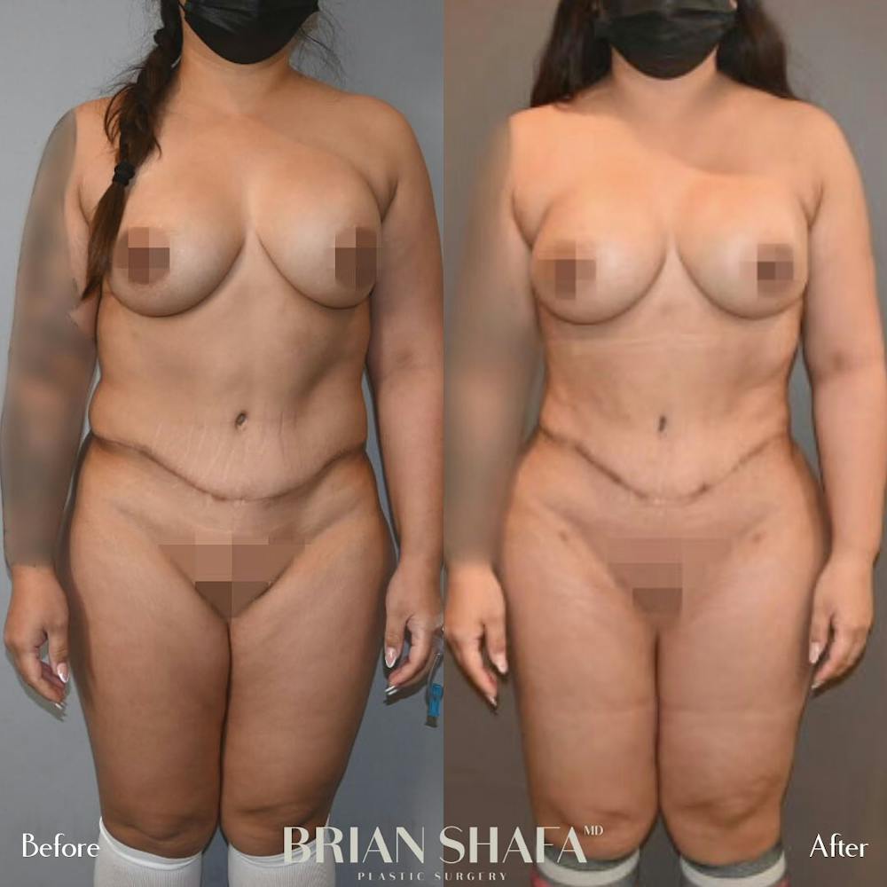 High-Def Liposuction  Before & After Photos - Patient 96913498 - Image 2