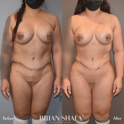 High-Def Liposuction  Before & After Photos - Patient 96913498 - Image 2