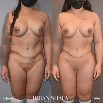 Brazilian Butt Lift Before & After Gallery - Patient 96913501 - Image 2