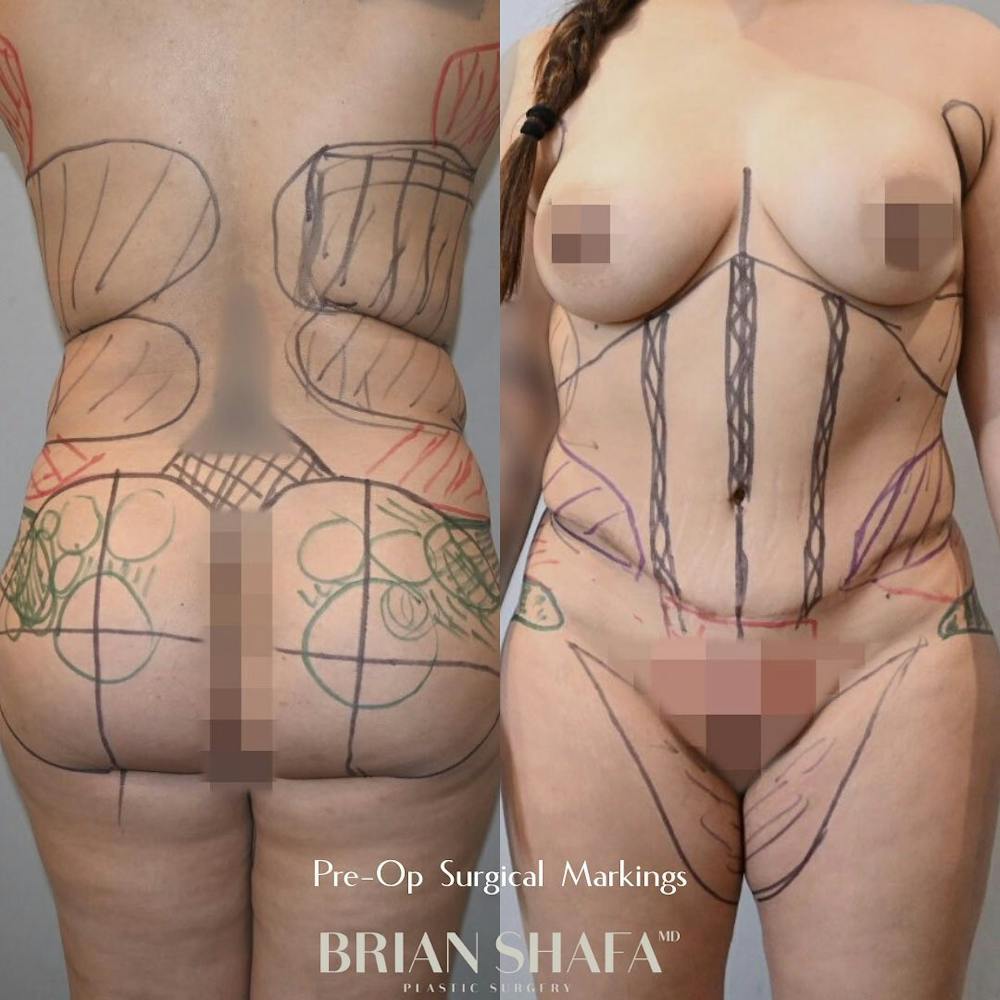 High-Def Liposuction  Before & After Photos - Patient 96913498 - Image 3