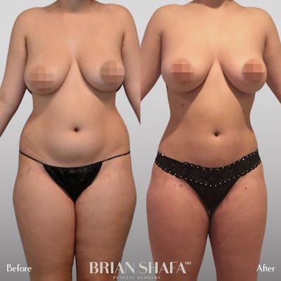 High-Def Liposuction  Before & After Photos - Patient 96913517 - Image 1