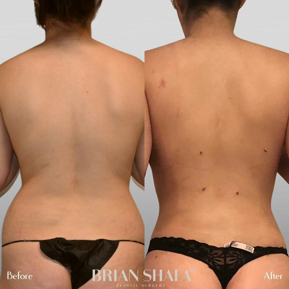 High-Def Liposuction  Before & After Photos - Patient 96913517 - Image 2