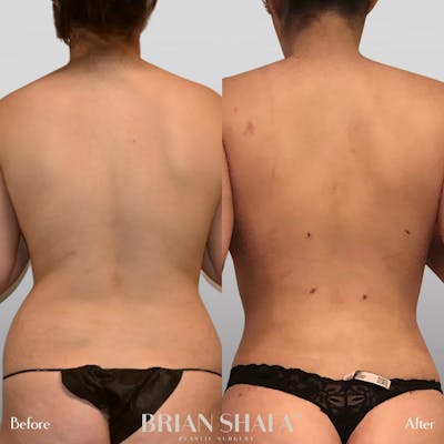 High-Def Liposuction  Before & After Photos - Patient 96913517 - Image 2