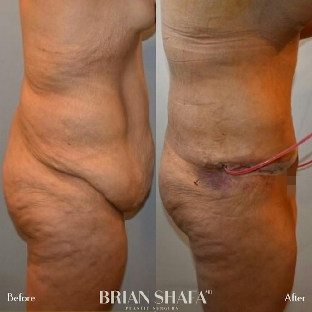 Tummy Tuck/ Abdominoplasty Before & After Gallery - Patient 96913538 - Image 1