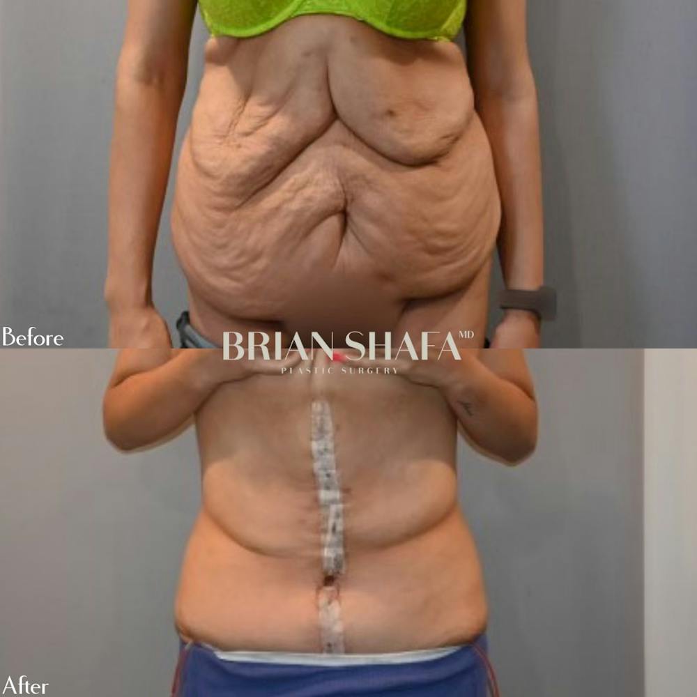 Tummy Tuck (Abdominoplasty) Before & After Photos - Patient 96913604 - Image 1