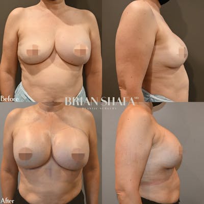 Breast Augmentation  Before & After Photos - Patient 96913621 - Image 1