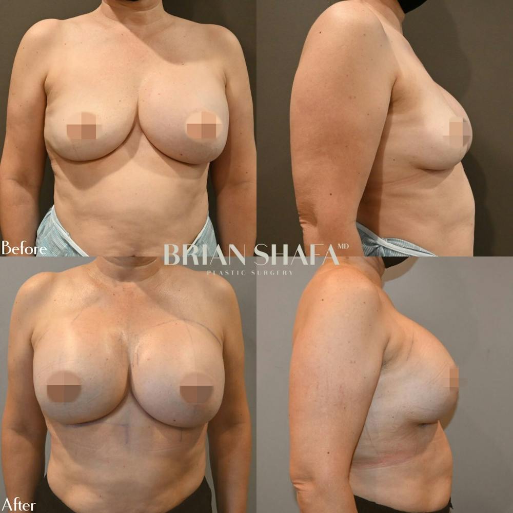Breast Augmentation  Before & After Gallery - Patient 96913621 - Image 1