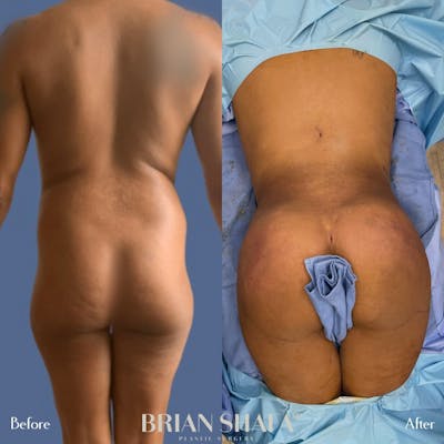 Brazilian Butt Lift Before & After Photos - Patient 96913638 - Image 1