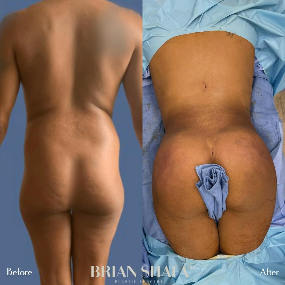 Brazilian Butt Lift Before & After Gallery - Patient 96913638 - Image 1
