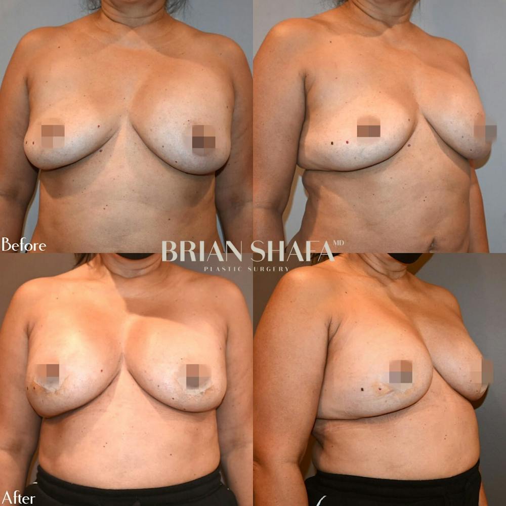 Breast Augmentation  Gallery - Patient 109121503 - Image 1