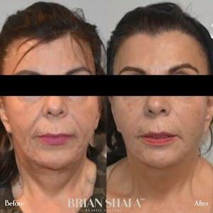 facelift in Beverly Hills & Santa Monica before and after photos