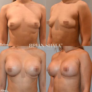 breast augmentation procedure before and after 2
