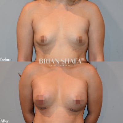 Breast Augmentation  Before & After Gallery - Patient 122876254 - Image 1