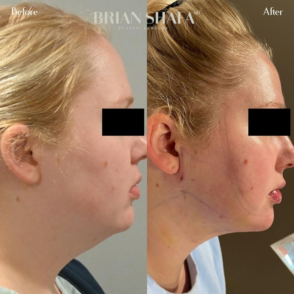 Jawline Contouring  Before & After Photos - Patient 122876260 - Image 1