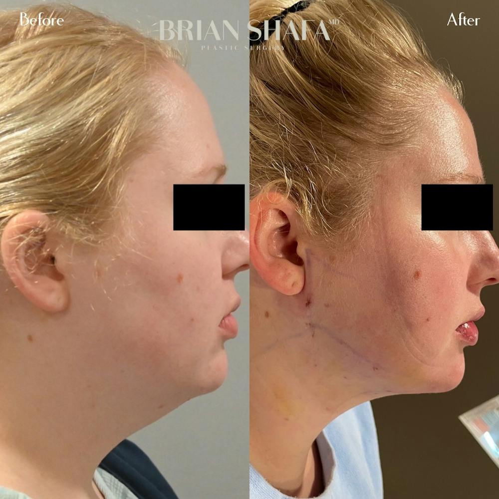 Jawline Contouring  Gallery - Patient 122876260 - Image 1