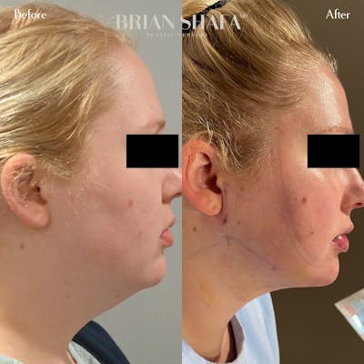 Jawline Contouring  Before & After Gallery - Patient 122876260 - Image 1