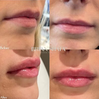 Injectables Before & After Photos - Patient 122876262 - Image 1