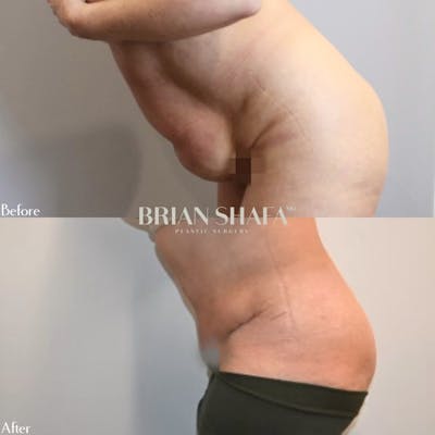 Tummy Tuck (Abdominoplasty) Before & After Gallery - Patient 122876272 - Image 1
