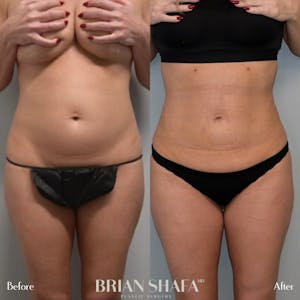 tummy tuck in Beverly Hills before and after photos