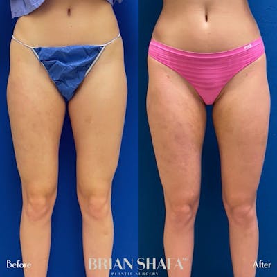 Liposuction Before & After Photos - Patient 122876288 - Image 1