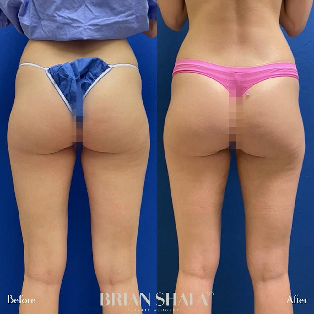 Liposuction Before & After Photos - Patient 122876288 - Image 2