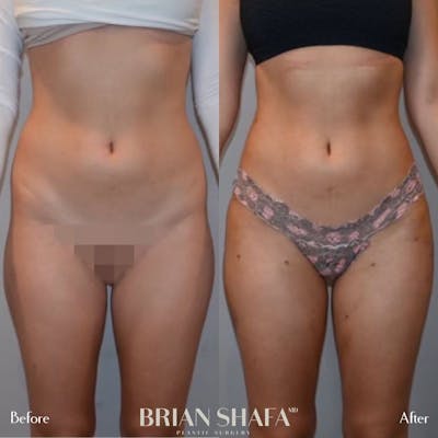 Liposuction Before & After Photos - Patient 122876289 - Image 1