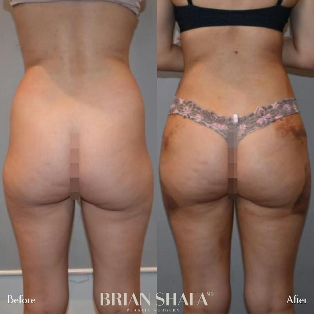 Liposuction Before & After Photos - Patient 122876289 - Image 2
